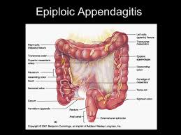 Ảnh 4 của Epiploic Appendagitis